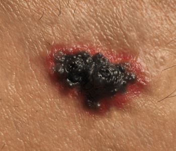 Best skin cancer treatment from inventor of Mohs Micrographic Surgery technique