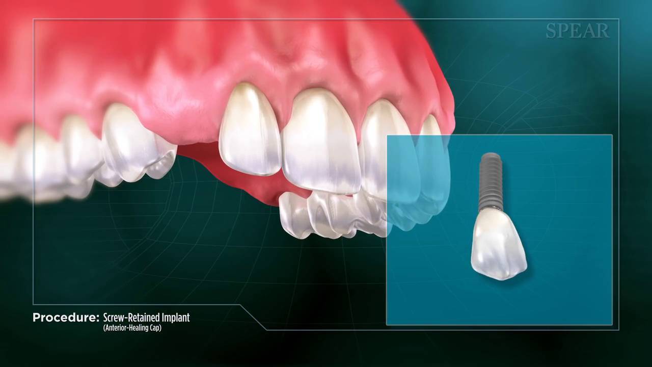 Screw - Retained Implant