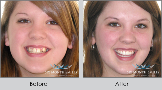 Smile Make Over Longview - Before and After Case 1