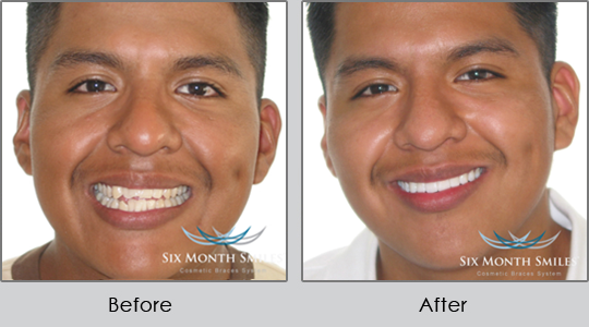 Smile Make Over Longview - Before and After Case 2