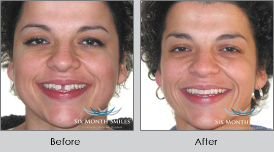 Smile Make Over Longview - Before and After Case 3