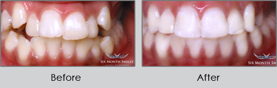 Smile Make Over Longview - Before and After Case 4