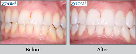 Tooth Whitening Longview - Before and After Case 1