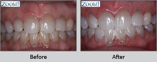 Tooth Whitening Longview - Before and After Case 2