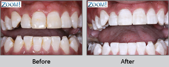 Tooth Whitening Longview - Before and After Case 3