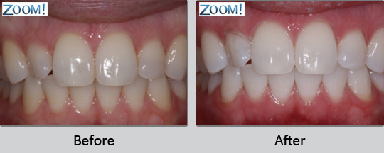 Tooth Whitening Longview - Before and After Case 4