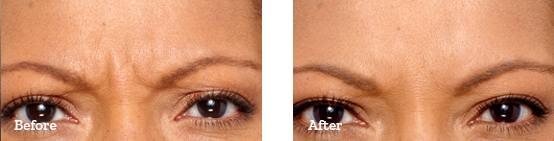 Botox Before After image 02