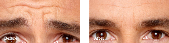 Botox Before After image 03