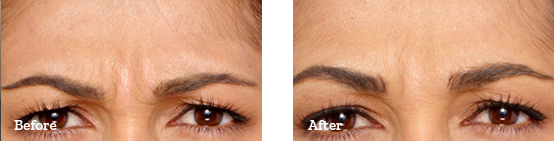 Botox Before After image 03