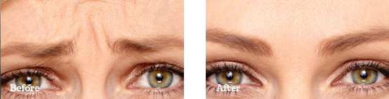 Botox Before After image 04