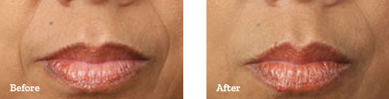 Juvederm Before After 01