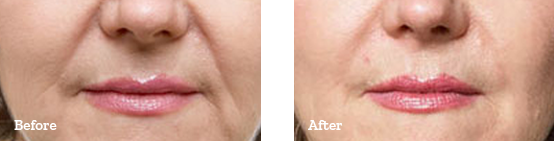 Juvederm Before After 02