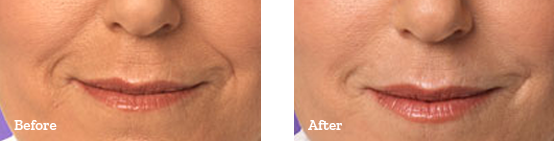 Juvederm Before After 04
