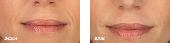 Juvederm Before After 05