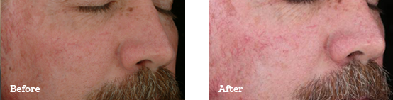 Photodynamic Therapy Before After 03