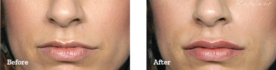 Restylane Before After image 12
