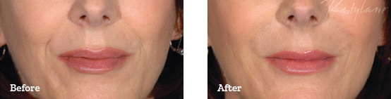 Restylane Before After image 04