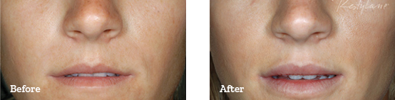 Restylane Before After image 09