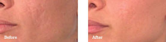 Laser 360 Before After image 01