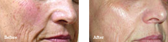 Laser 360 Before After image 02