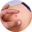 Skin cancer/MOHS Surgery