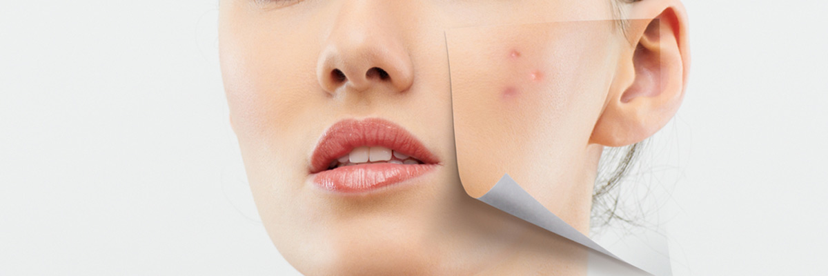 girl with acne