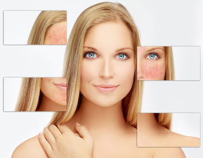 Actinic Keratosis