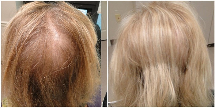 Before Image 3, Restylane Plano