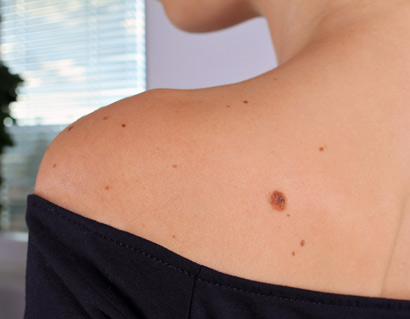Brown Spots 