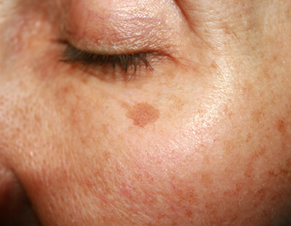 Brown spots under the eye.