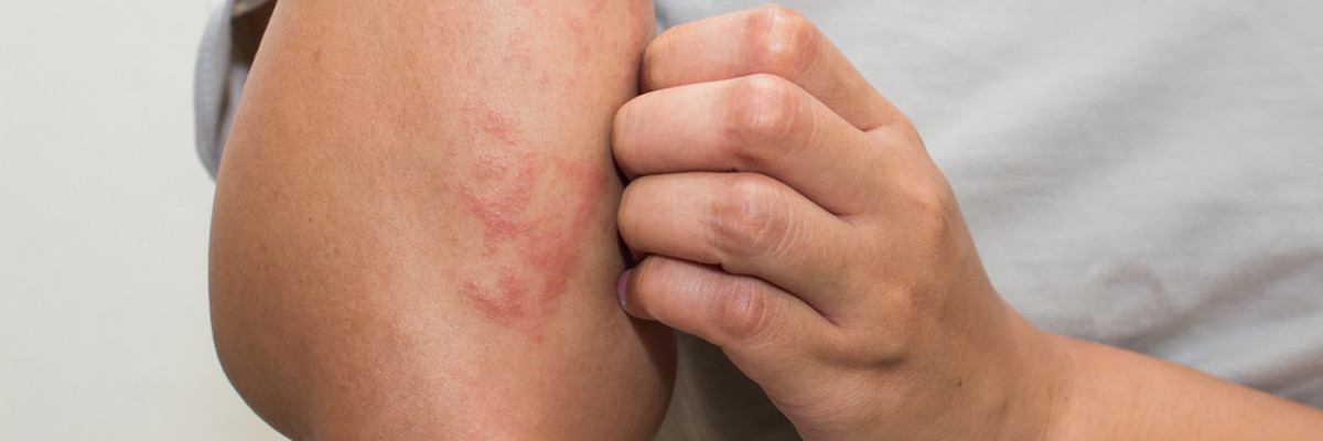 ill allergic rash dermatitis eczema skin of patient