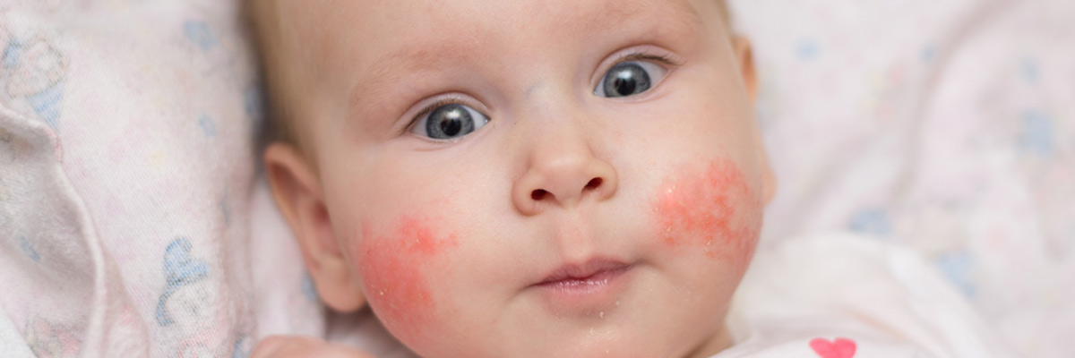 Surprised little baby girl with an allergic rash on her cheeks lies on her back