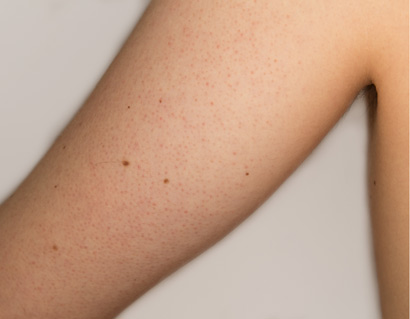 Keratosis-pilaris