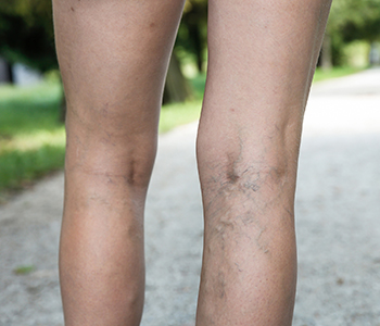 Painful varicose and spider veins on womans legs