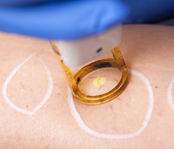 Dr. Selkin Bryan at Dermatology Center explains how a laser treats a vein.