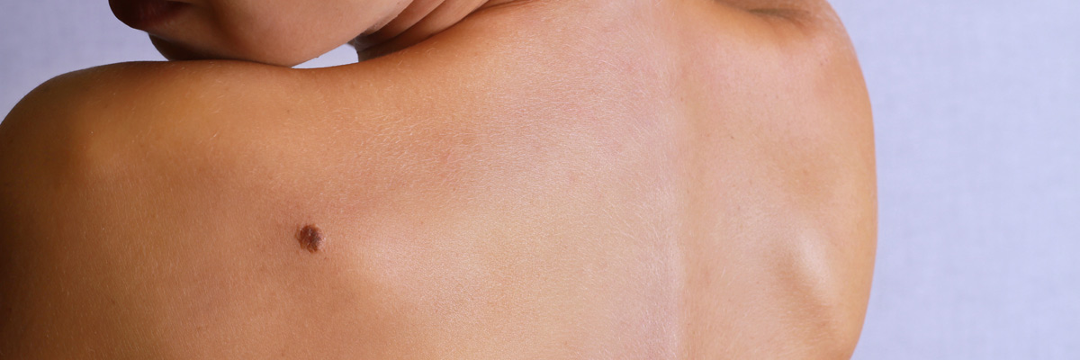 Young woman lookimg at birthmark on back