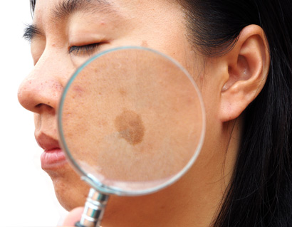 Doctor examining patient with melasma