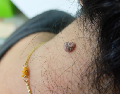 Benign Nevus at tbe back of neck