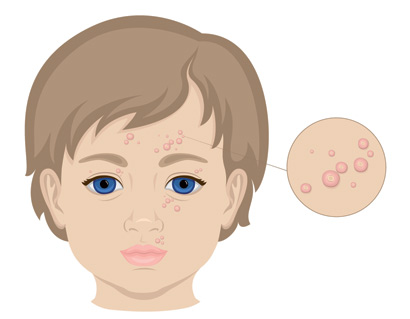 Illustration of Molluscum contagiosum
