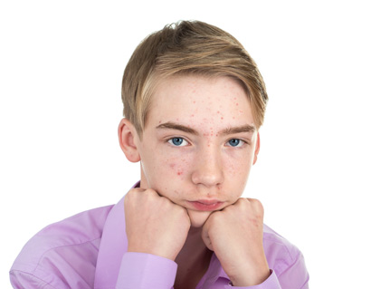 Boy with acne