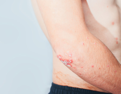 Psoriasis on elbows