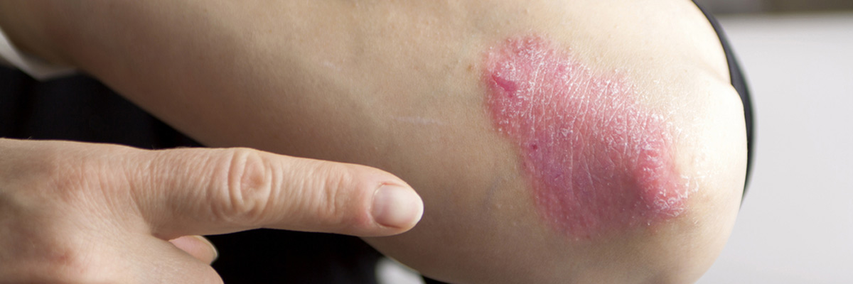 Psoriasis on elbow