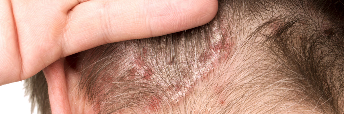 Detail of Psoriasis Vulgaris, skin disease