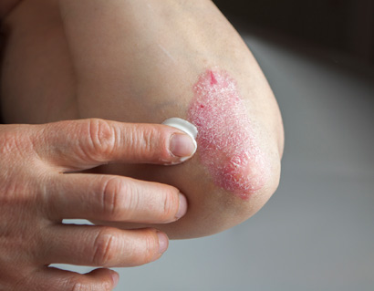 Psoriasis on elbow