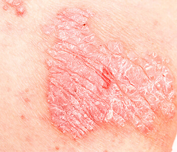 Dr. Selkin Bryan at Dermatology Center explains How you can start treatment for psoriasis.