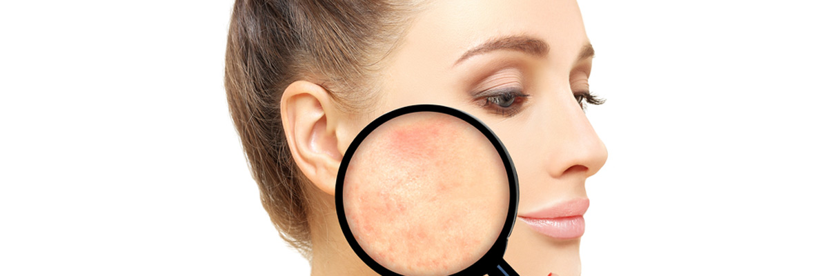 Post-Acne Marks