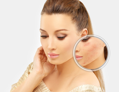 Post-Acne Marks /Treating Acne Scars.Acne Scar Removal