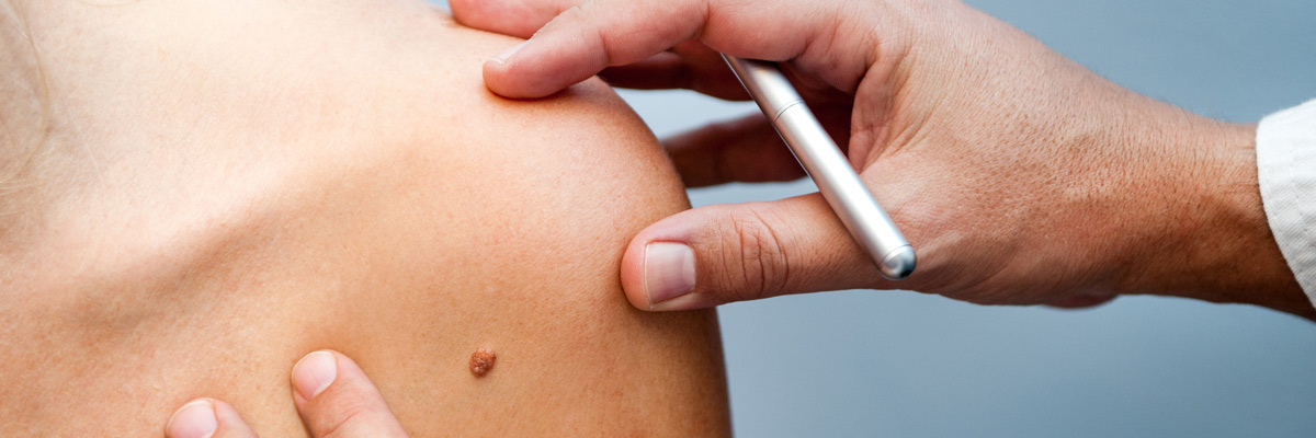 Birthmark