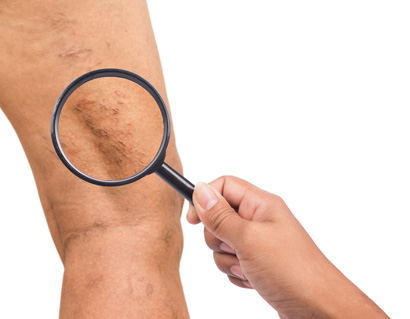 Varicose veins on the legs of middle-aged women