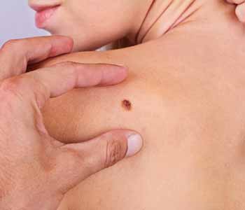Image of a Dermatology examine a Patients birthmark